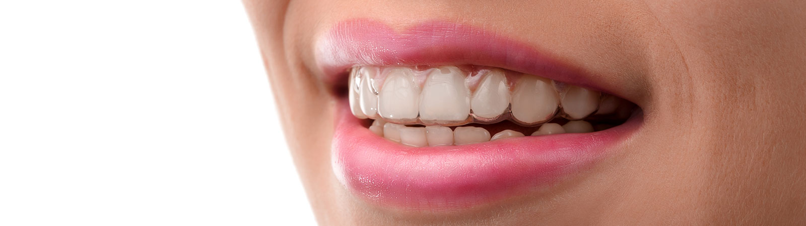 Invisalign Clear Braces Grand Rapids - Teeth Straightening